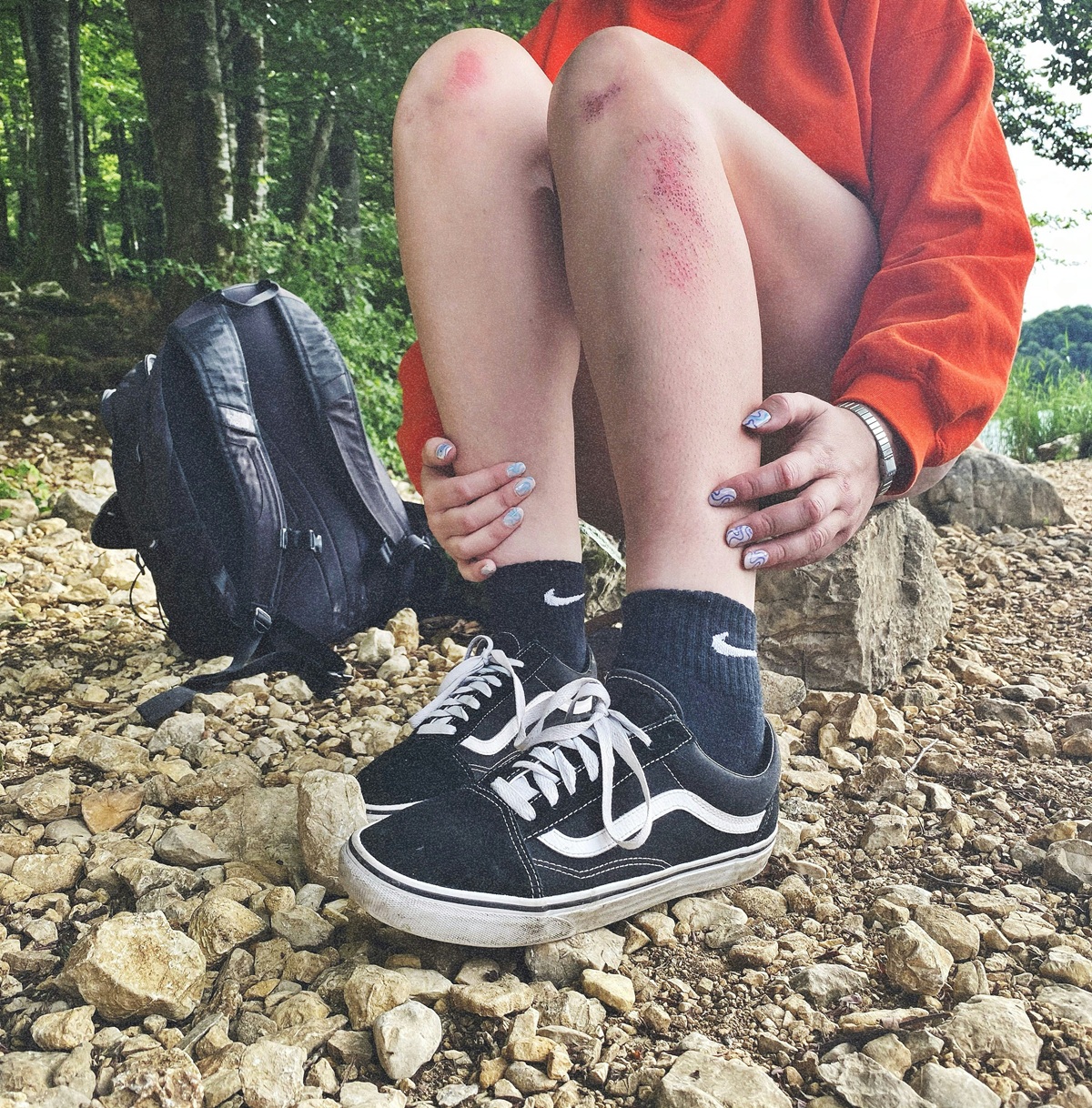 Athlete nursing a sore leg